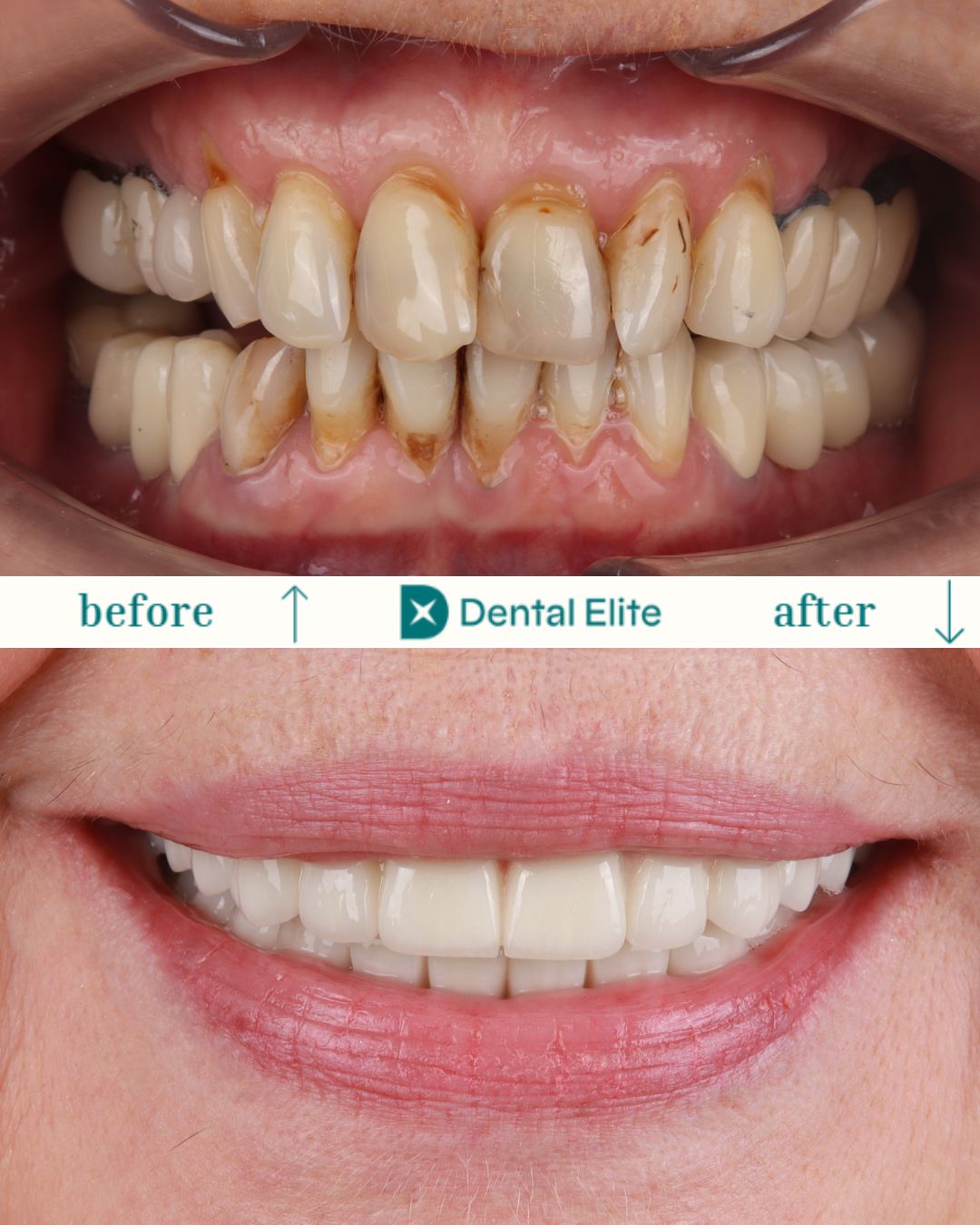 before after caz 5